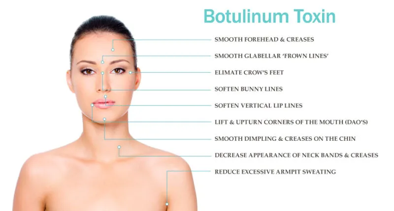 स्लिमिंग विरोधी झुर्रियां Beutox Batulaxs Resty Dermal Filler Juvederms 0