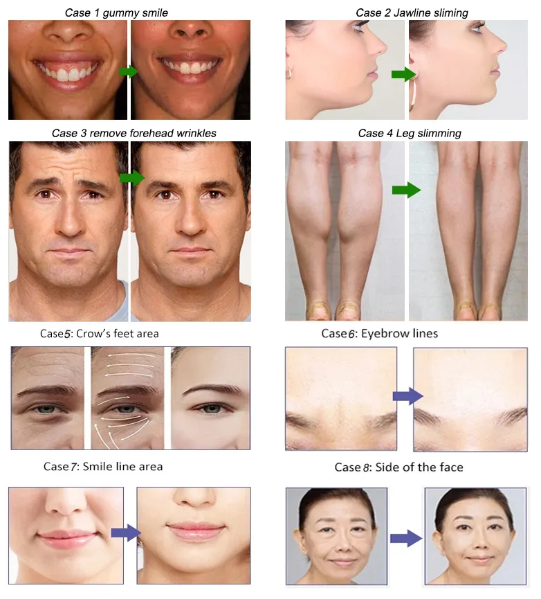 स्लिमिंग विरोधी झुर्रियां Beutox Batulaxs Resty Dermal Filler Juvederms 1